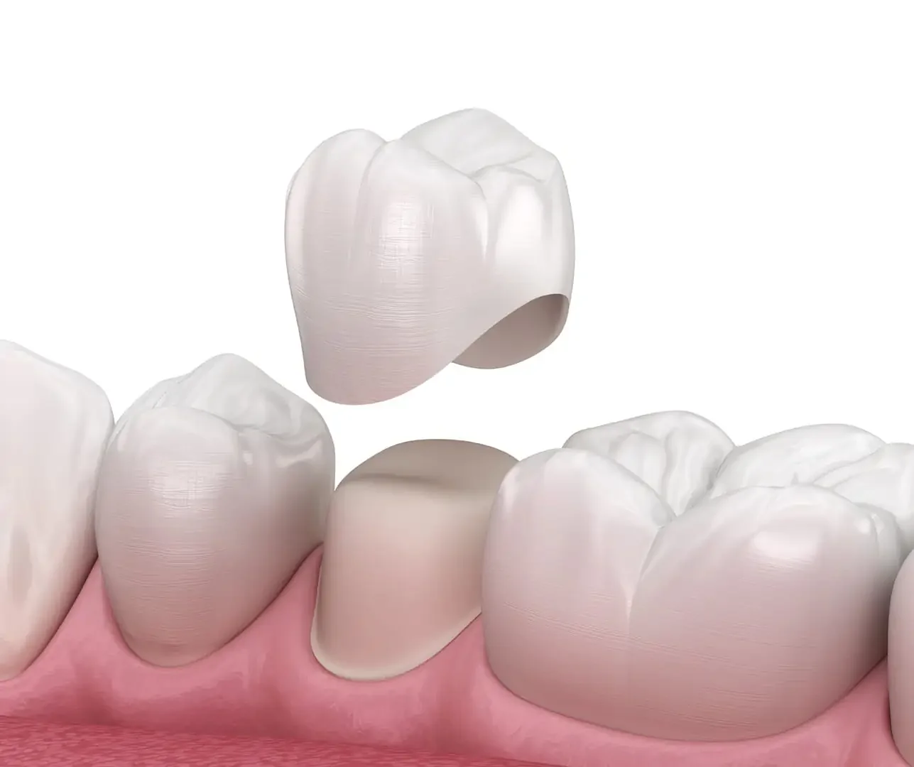Crowns at Refined Smiles