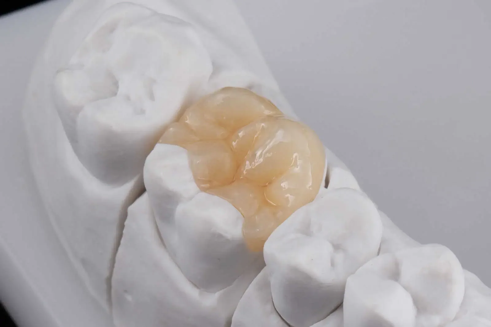 Inlays & Onlays at Refined Smiles