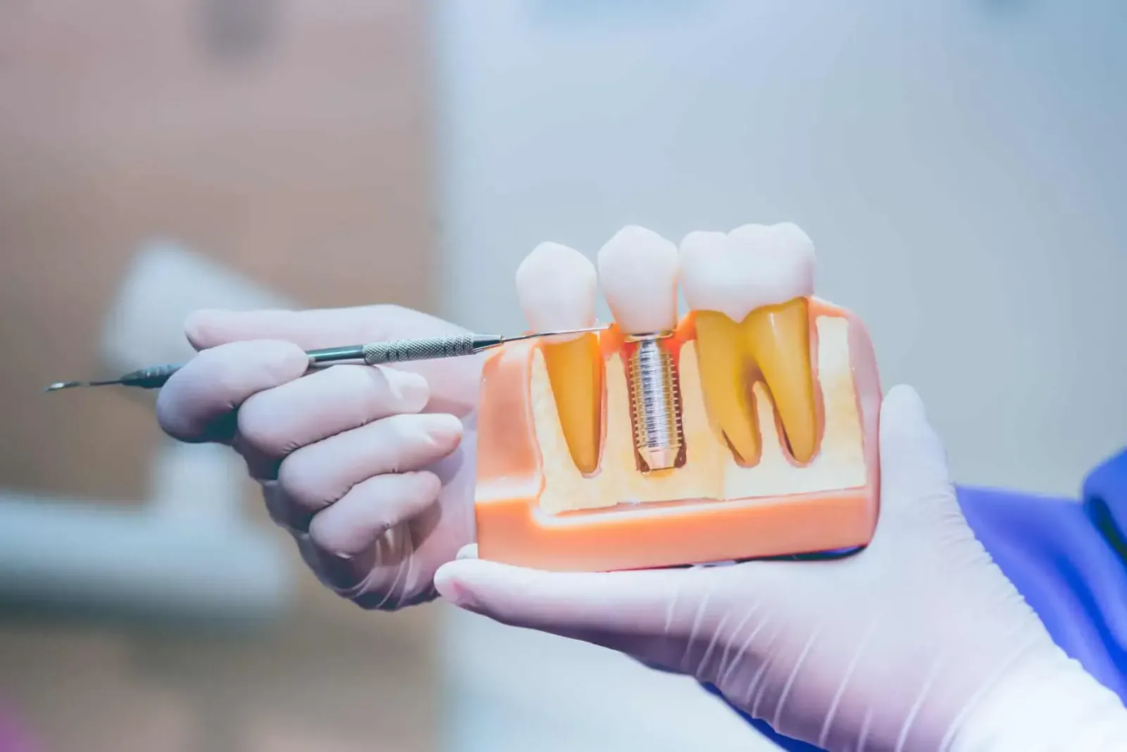 Dental Implants at Refined Smiles